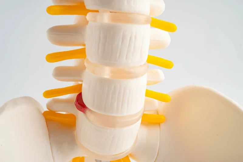 Sciatic Nerve Model Shown in a South Florida, Spine Surgery Clinic