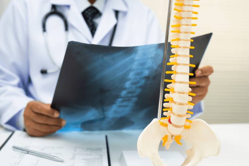 Spine Surgeons in South Florida Examine a Spinal Fracture X-Ray